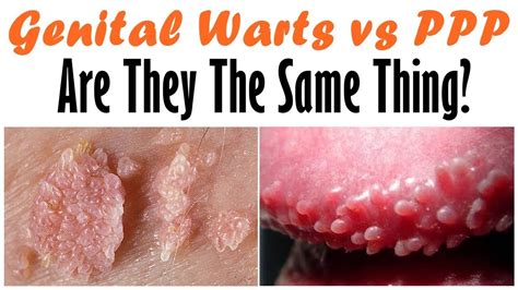 mens pp|penile papules vs warts.